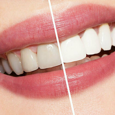 Λεύκανση δοντιών: Πώς γίνεται -Συμβουλές για ένα λαμπερό χαμόγελο