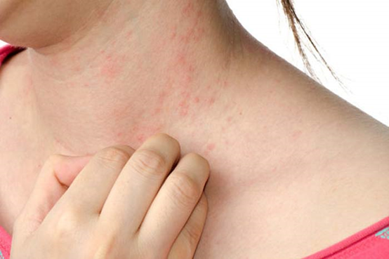 Αν έχεται αυτά τα αλλεργικά συμπτώματα, τότε έχετε πρόβλημα με ακάρεα στο σπίτι