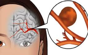 Ποια είναι τα SOS συμπτώματα του ανευρύσματος εγκεφάλου που δεν πρέπει να παραβλέπουμε;